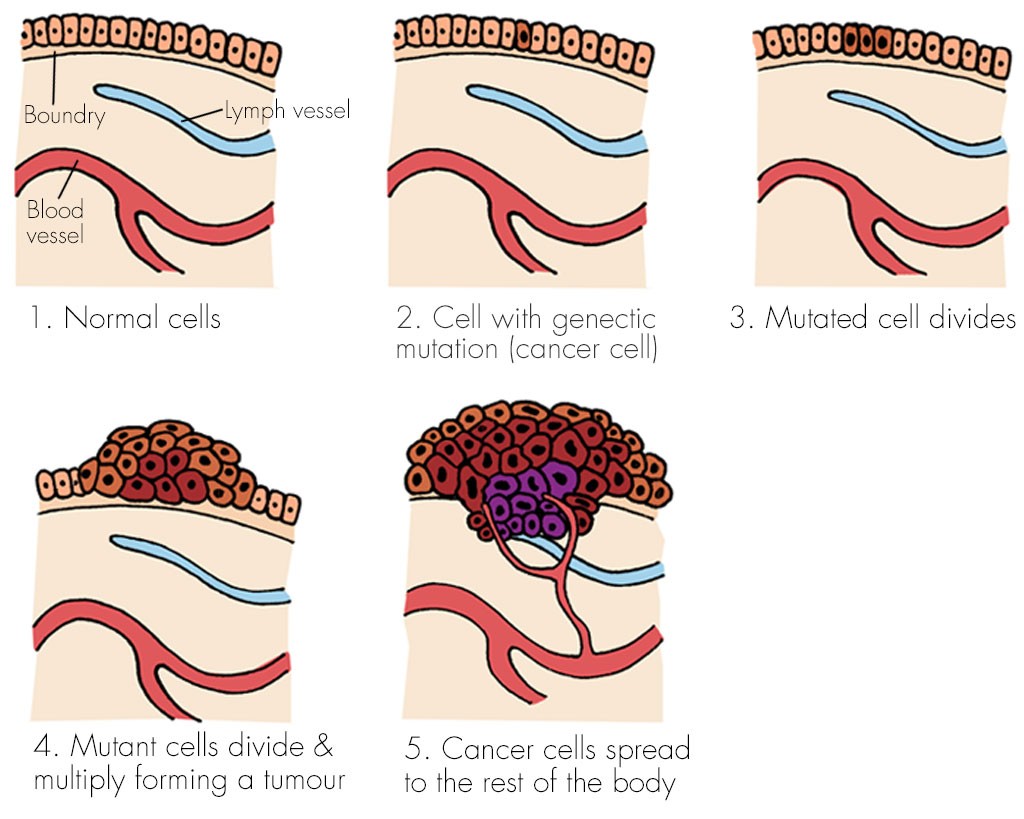 Stages of cancer