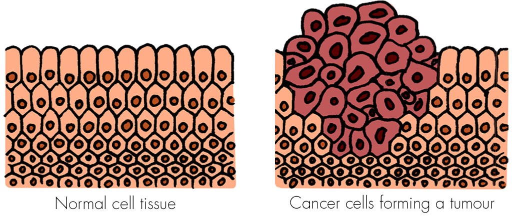 Cancer cells forming a tumour